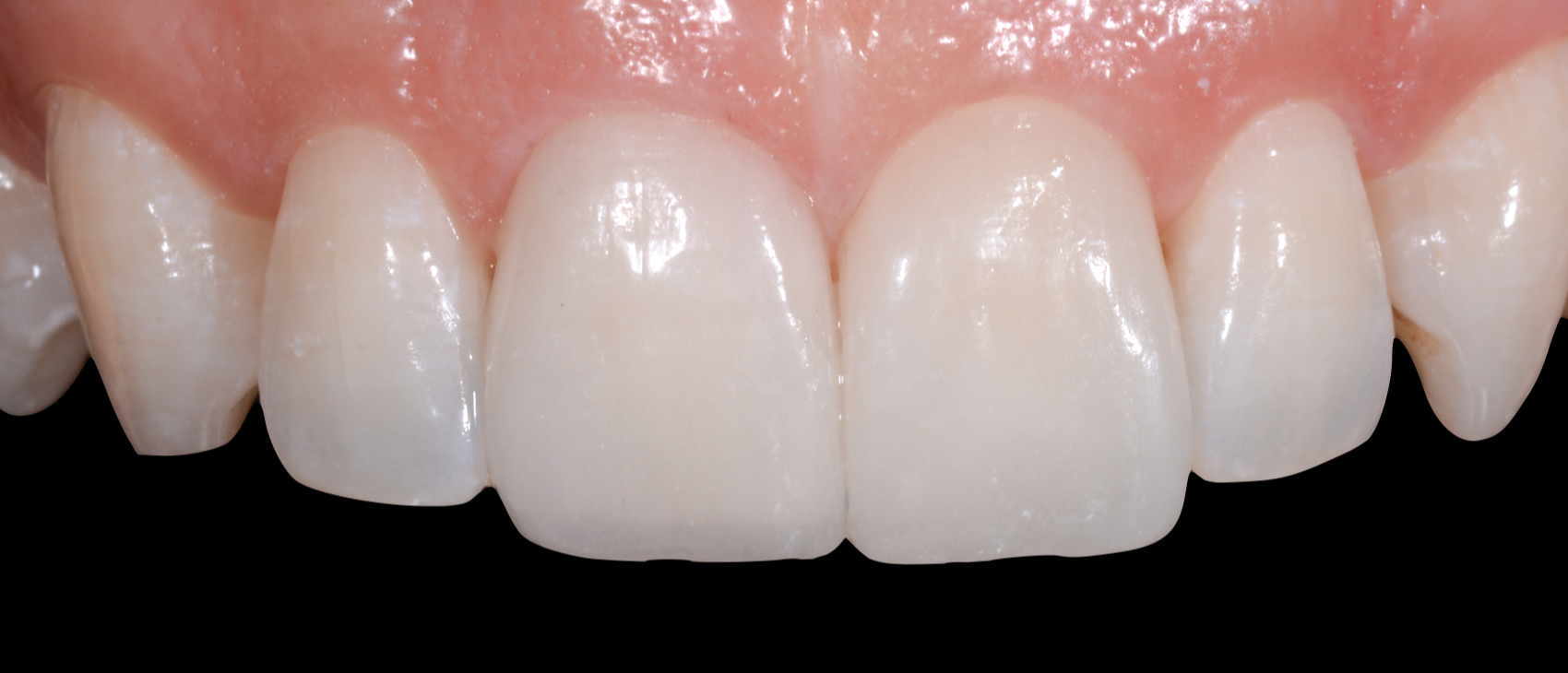 Le faccette dentali: l'ortodonzia Istantanea