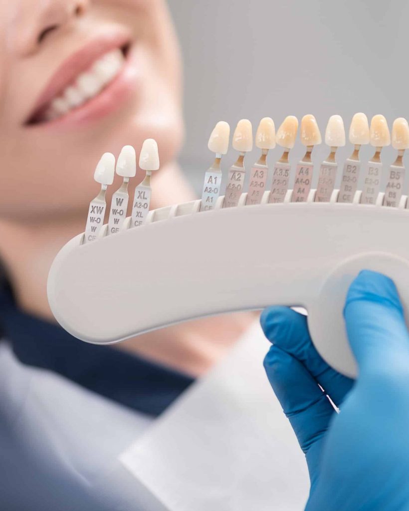 faccette-estetiche-promes-milano faccette-estetiche-promes-milano